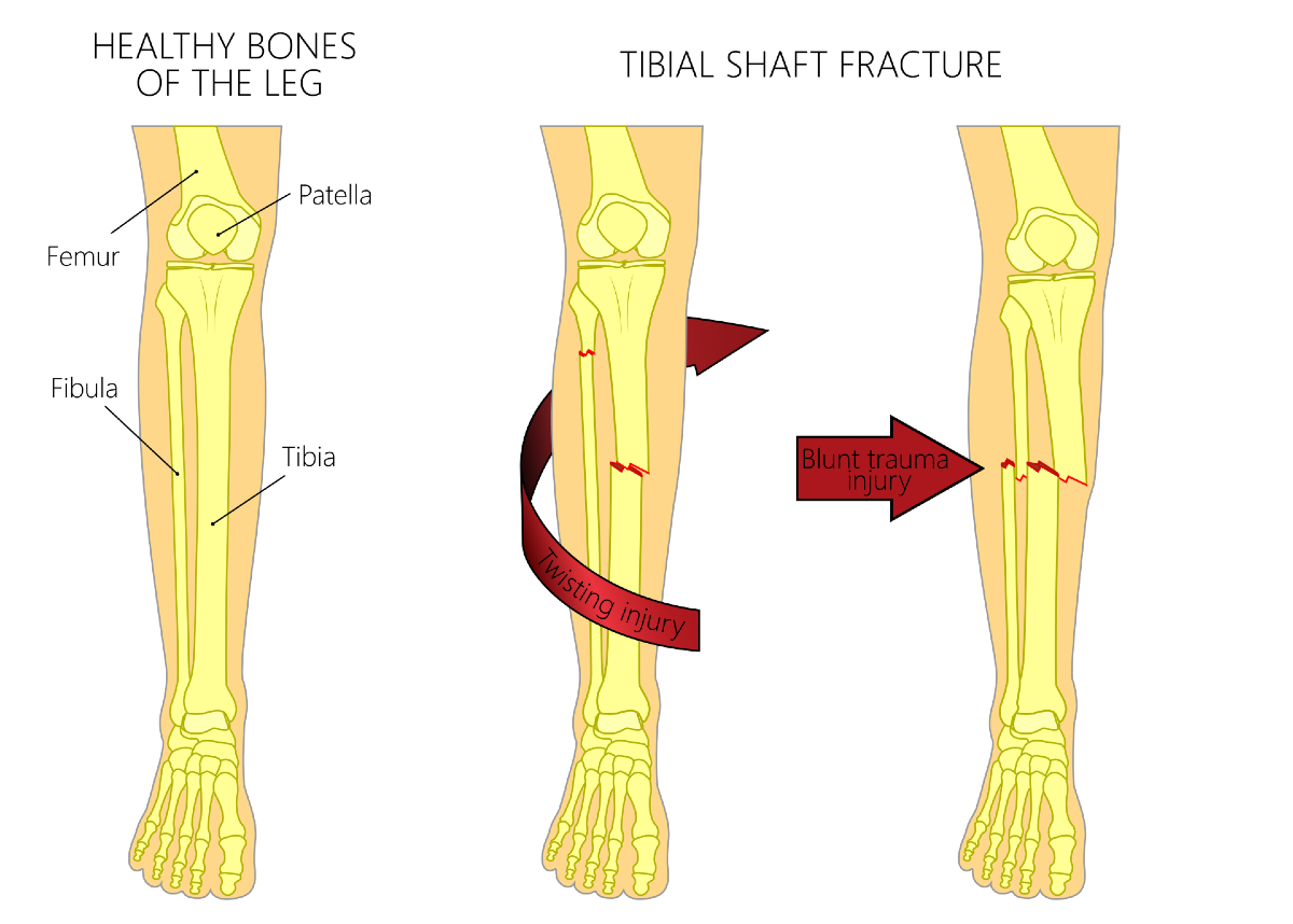 Tibia and Fibula 